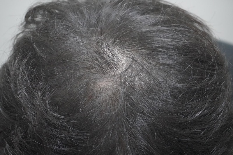 [탈모진단] 뉴헤어부산 탈모 치료 상담, 탈모 치료 4회 차 후기