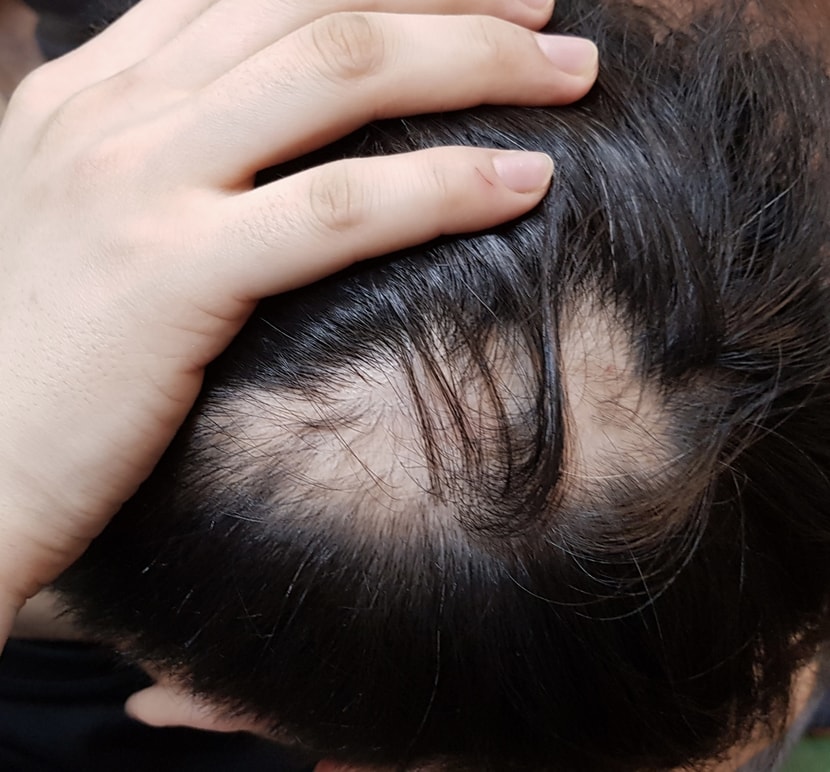 엄청 심각해지는 원형 탈모