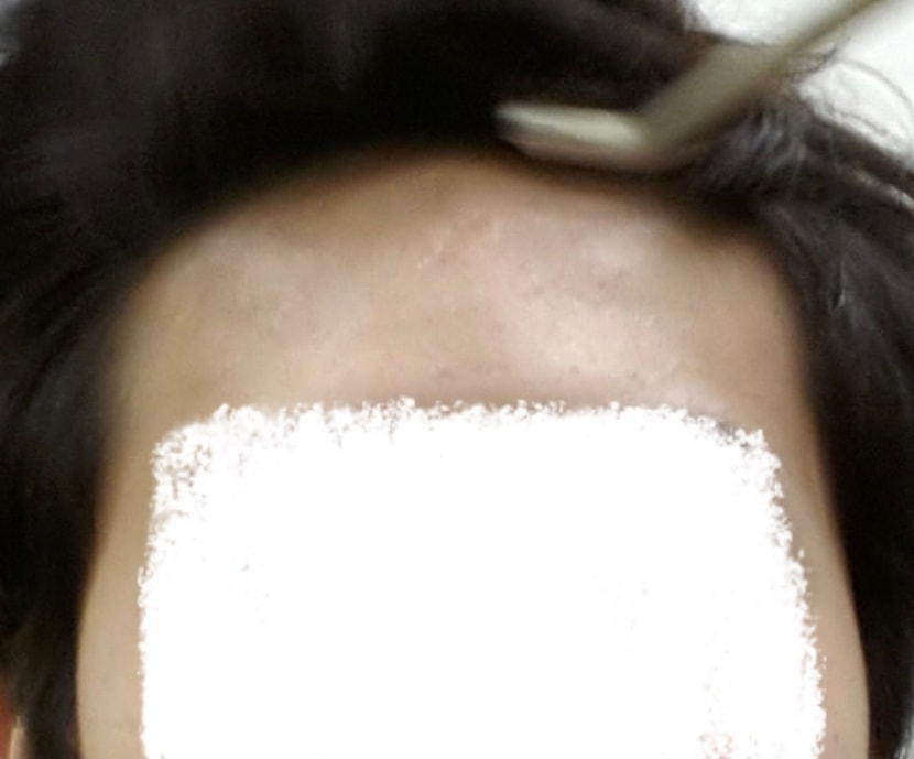 이건 19살 때 이마 상태