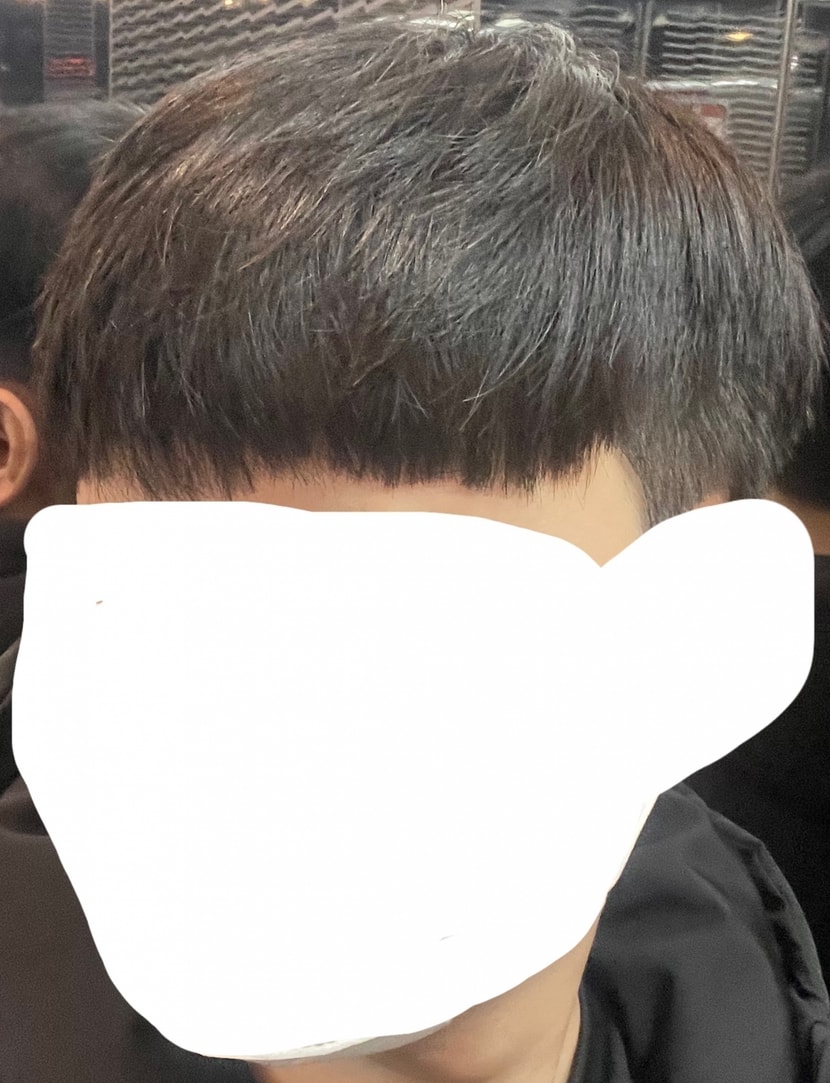 2년 정도 후 거의 다 나았을 때