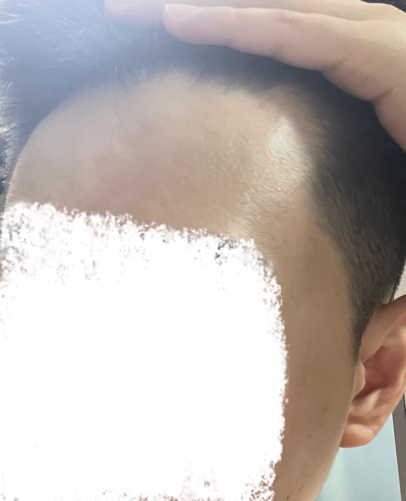 이건 28살 현재 이마 상태..