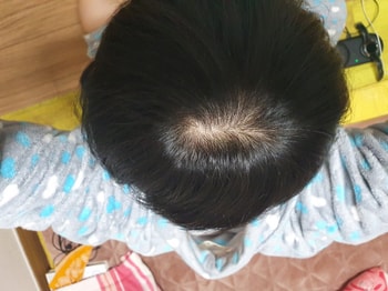 프로페시아 17개월