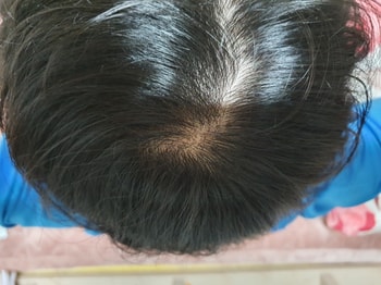 프로페시아 17개월