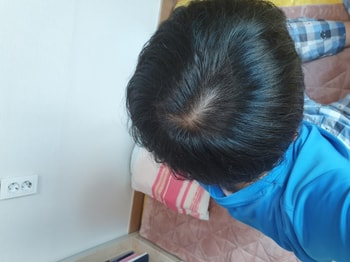 프로페시아 17개월