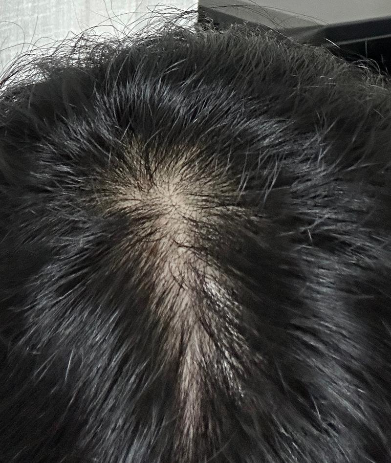 미녹시딜 + 모낭주사