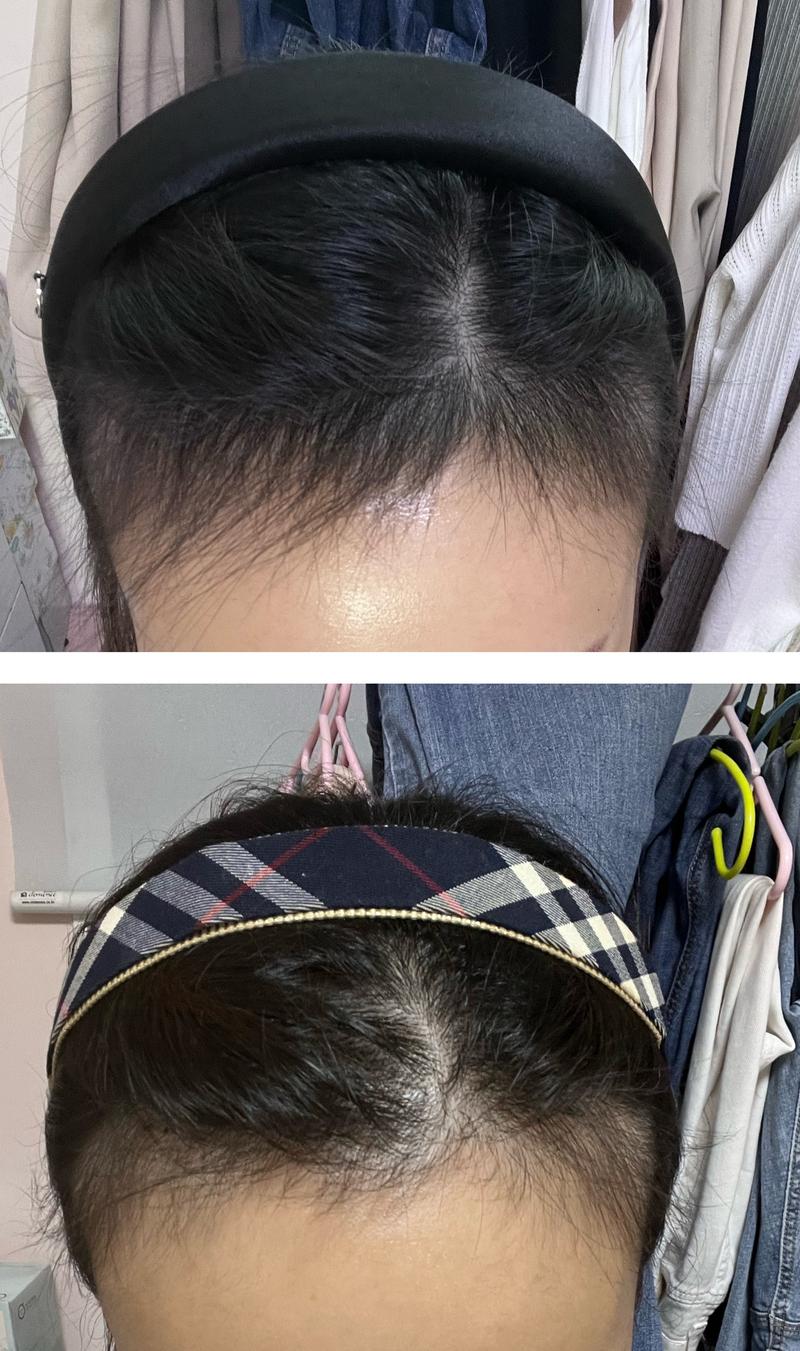 ミノキシジル錠を中断しました