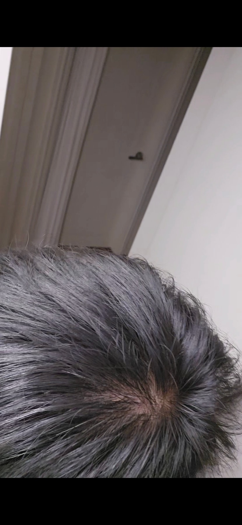 탈모인가요