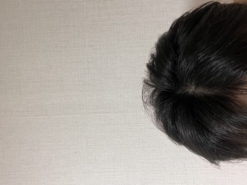 두타 6개월후 피나 2주차 머리 가늘어짐