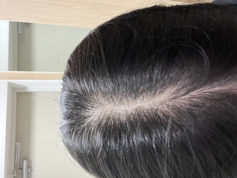 시술 당일 물로만 헹굼