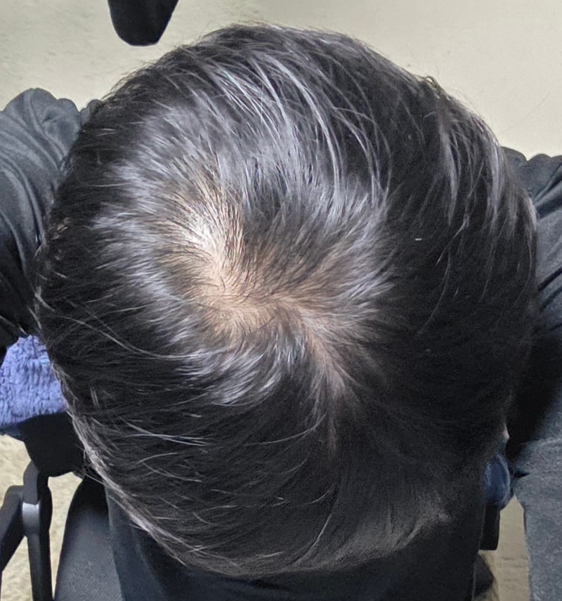 저 정도면 탈모 어느정도 일까요 26살