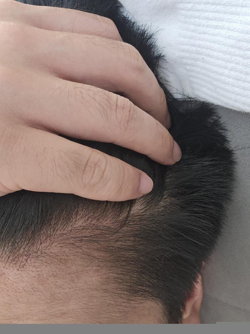 Should I take the combination medicine (Minokjeong + Aldactone) or antihistamines + just Fina