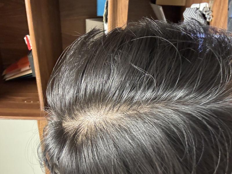 25세 남성 탈모 고민입니다 평가해주세요