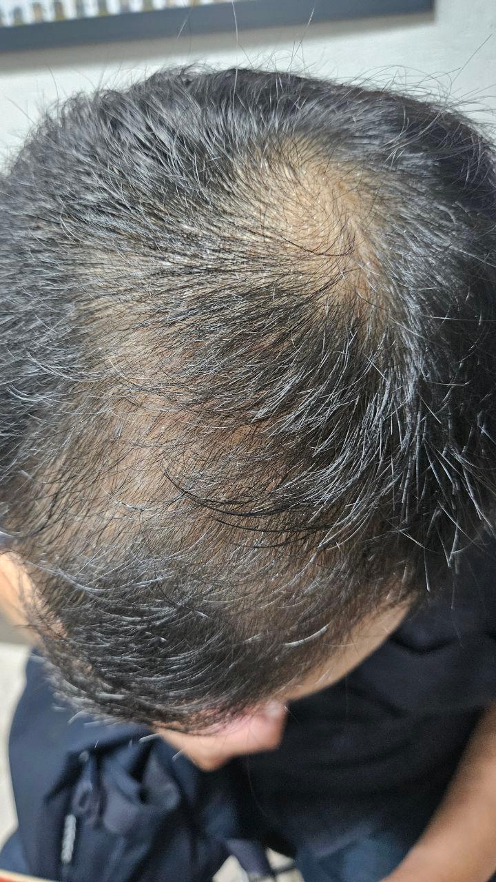 아보다트 카피약 8개월 후기