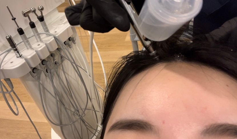 두피스케일링