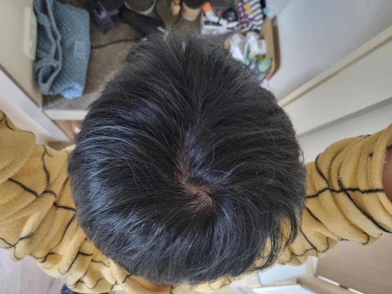 탈모의심인데 탈모일까요?...