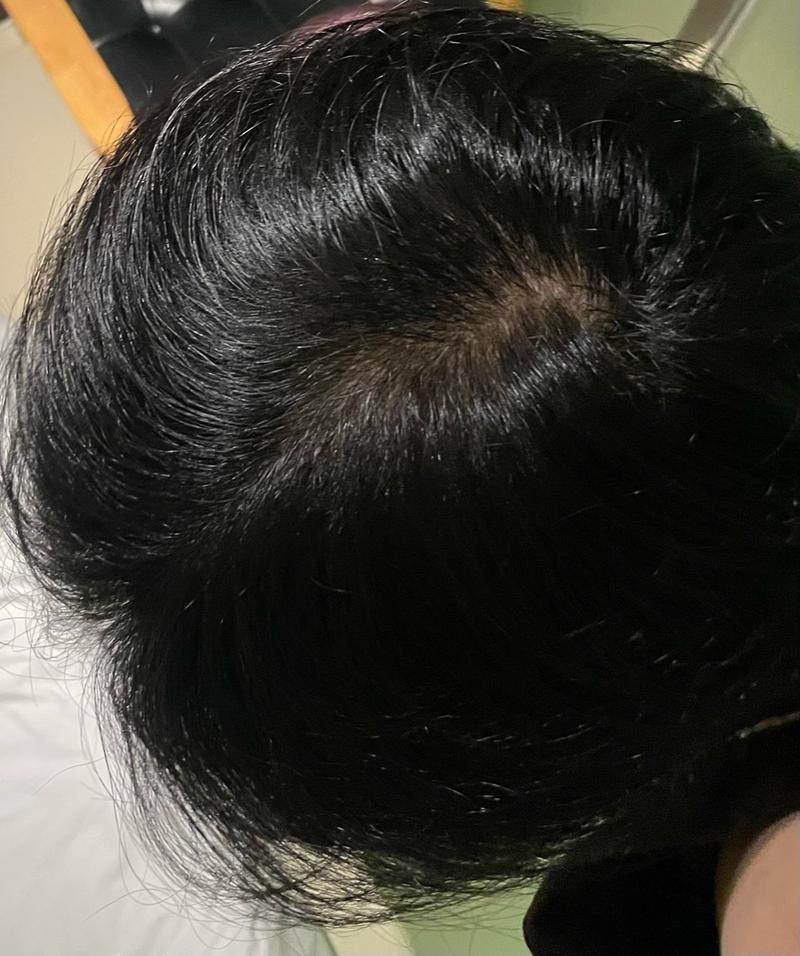 탈모약 8개월 째인데 괜찮은거같나요