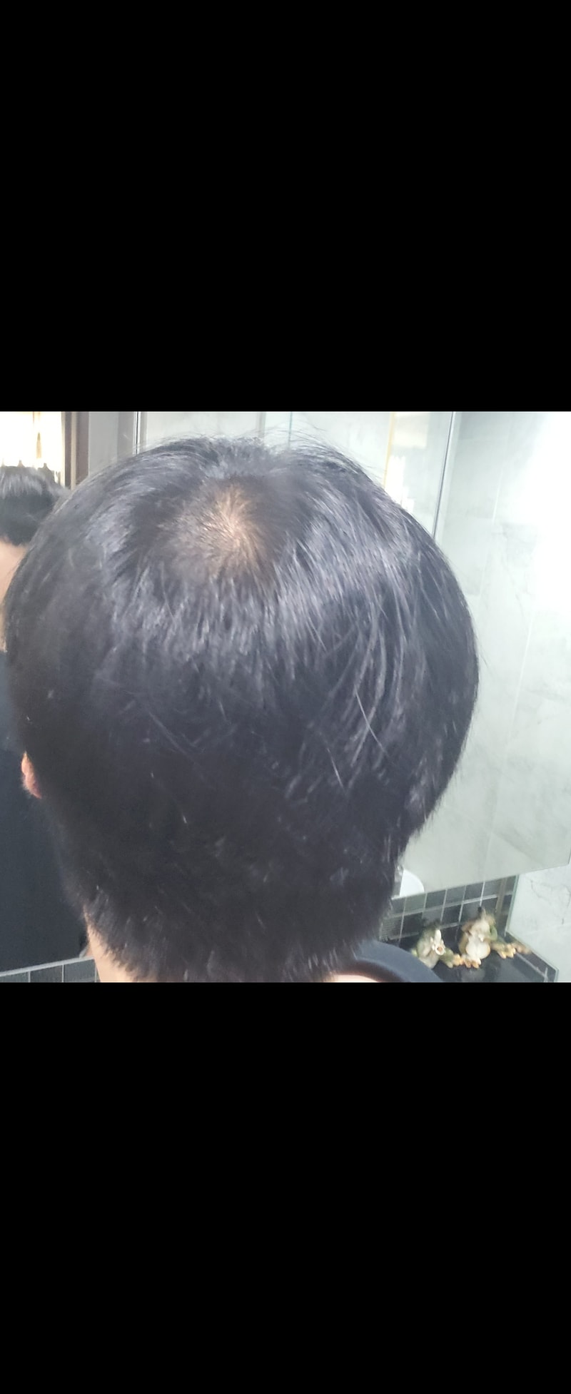 20대 중반 탈모 어떤가요..?