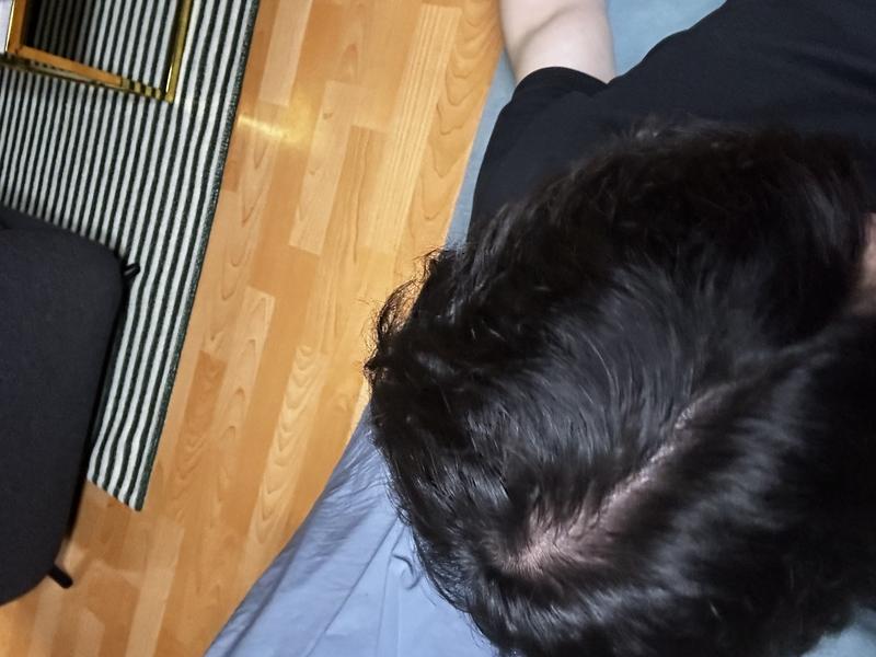 これは頭髪脱毛ですか、それとも男性型頭頂部脱毛ですか