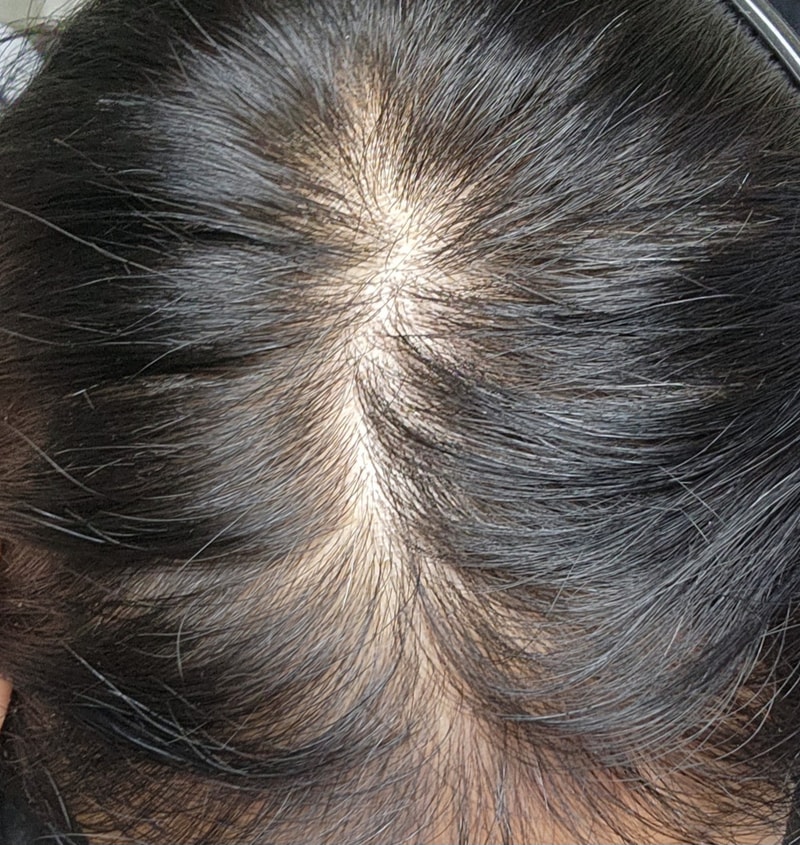 30중여자 m 모발이식 7개월 됬는데요