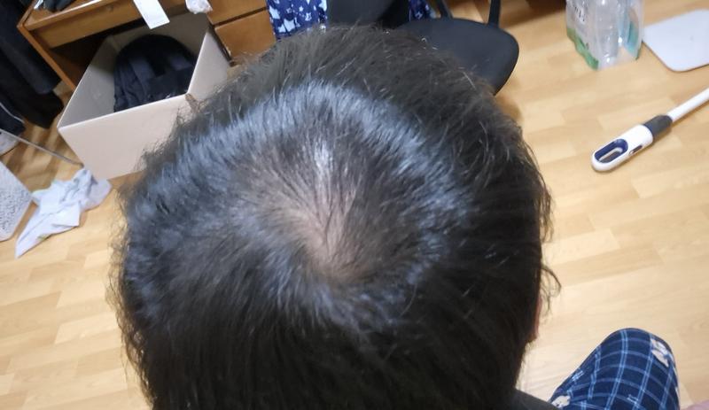 탈모약 6주 복용 후기