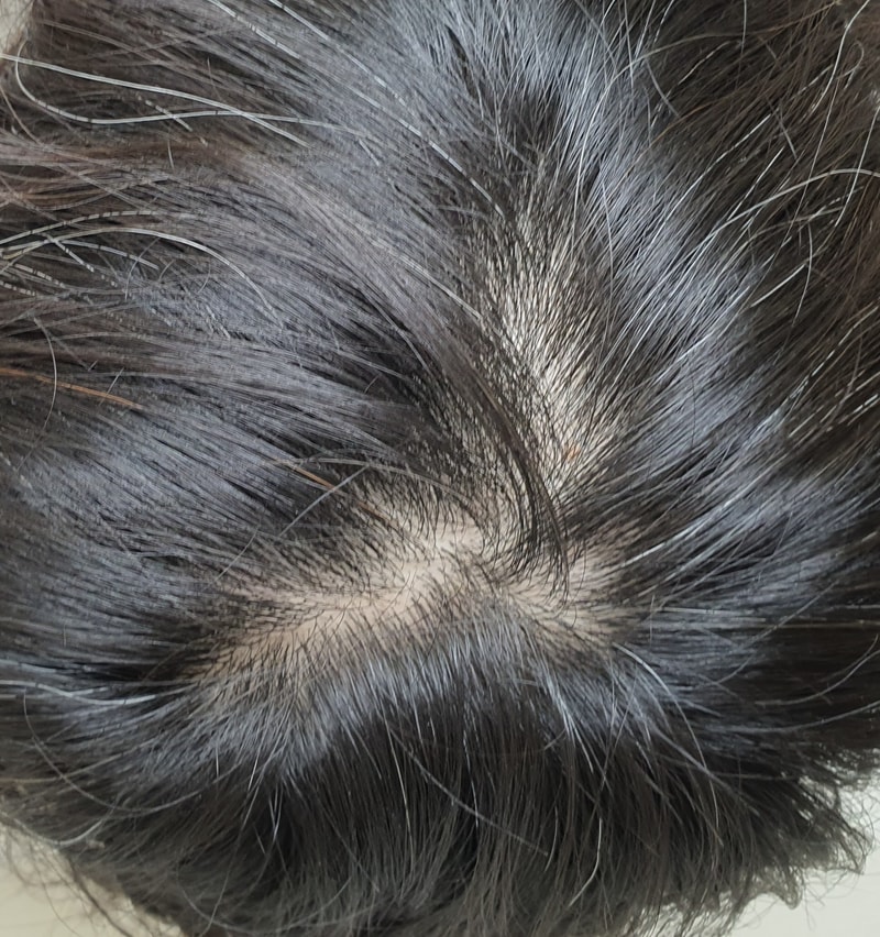 놀랍게도 이 머리는 탈모가 아닙니