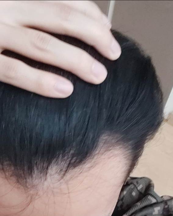 m자 탈모 1년 후기