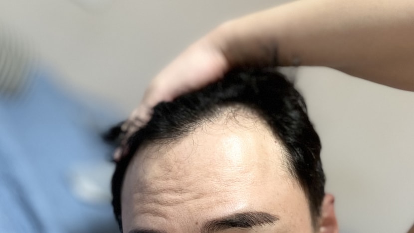 좌측이마