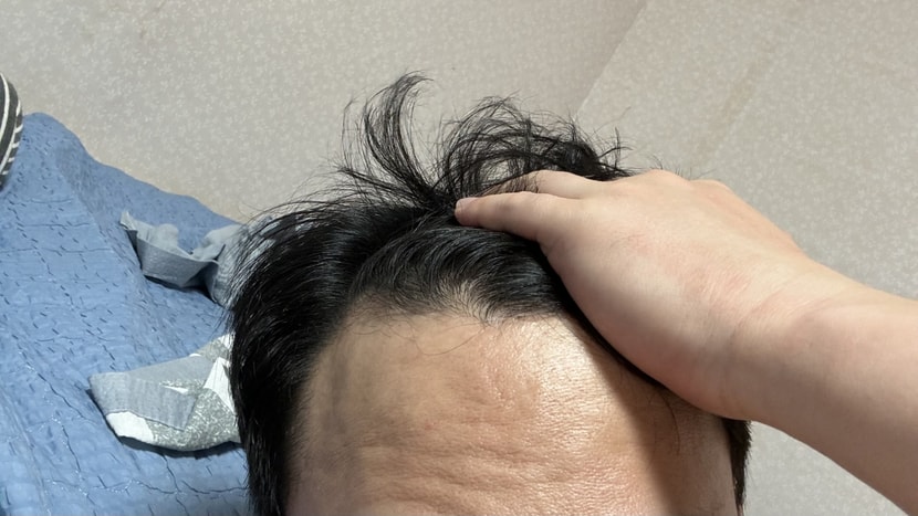 우측이마  