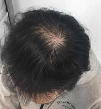 치료 시작 (2023.04)