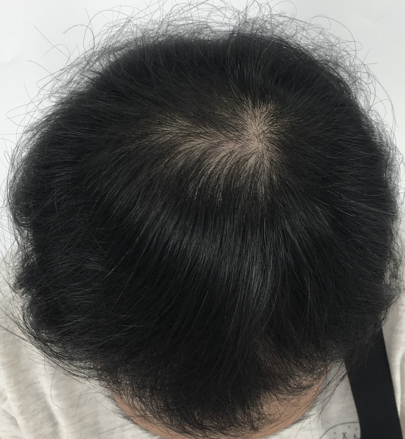 12회 치료 (2023.08)