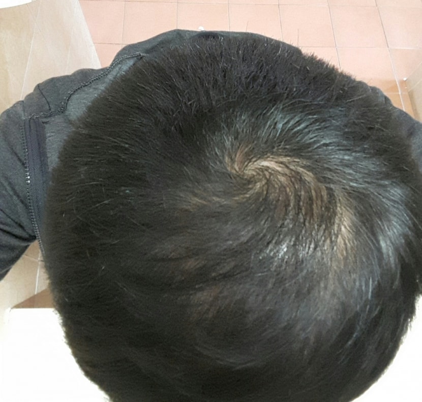 부랴부랴 프로스카를 복용한지 이제 한달이 안되었구요ㅜㅜ