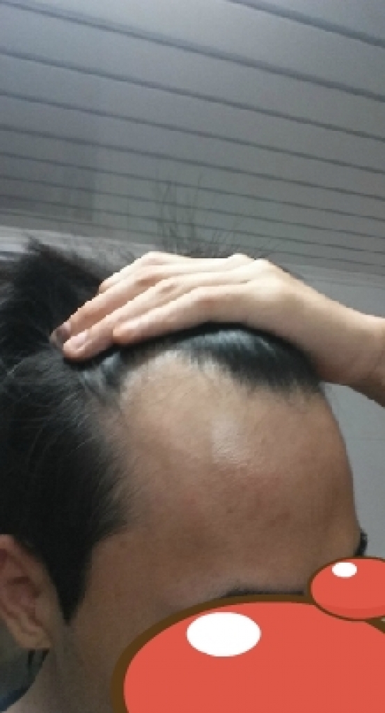 이마의 우측입니다.