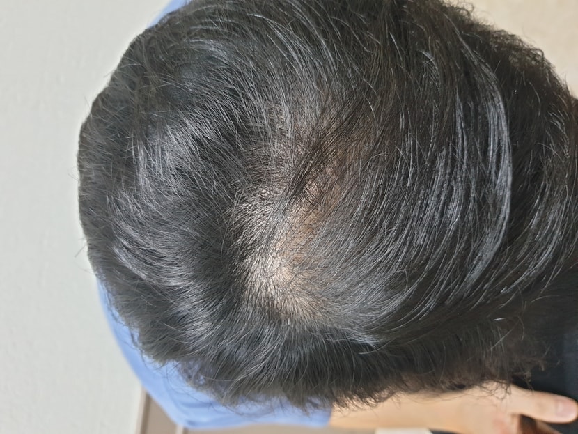 로게인폼 2달 사용