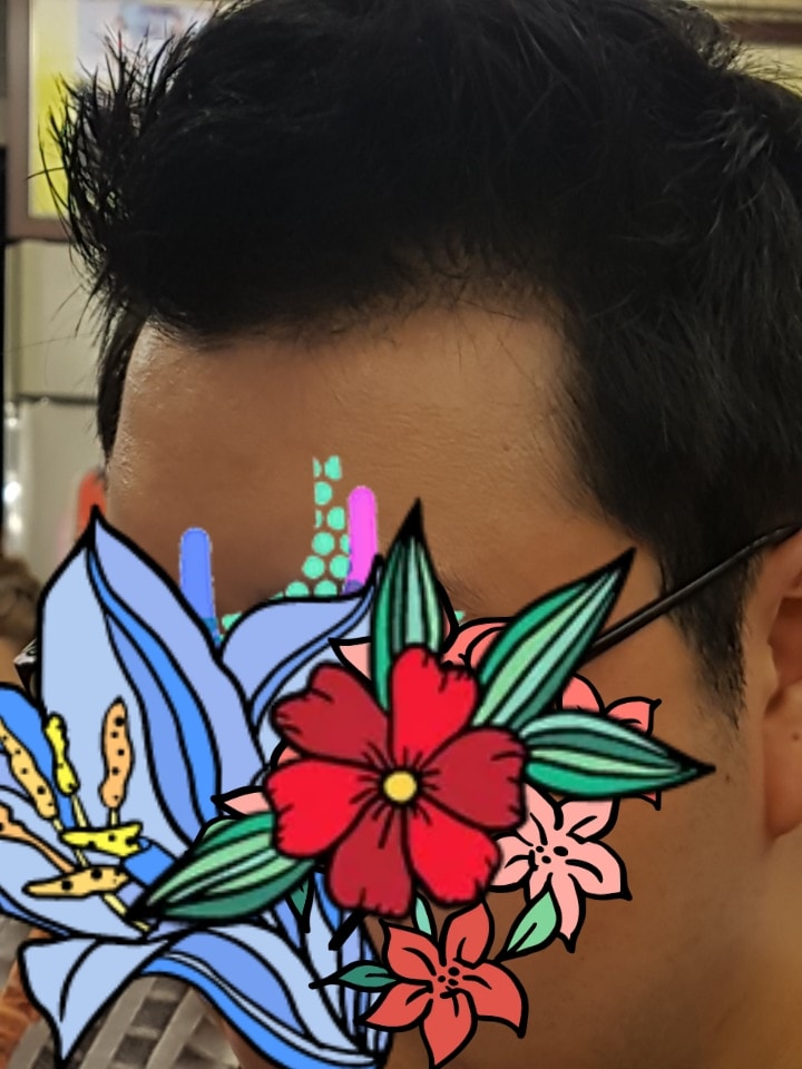 탈모 후 2018년 현재