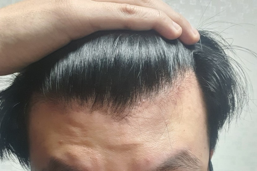 탈모 초기 진단 받았을 때 사진입니다.