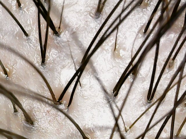 頭頂部、前頭部の顕微鏡撮影してみました。 新生毛の有無を確認してください。 + ミノキシジル錠