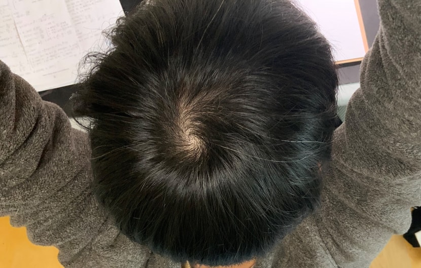 정수리