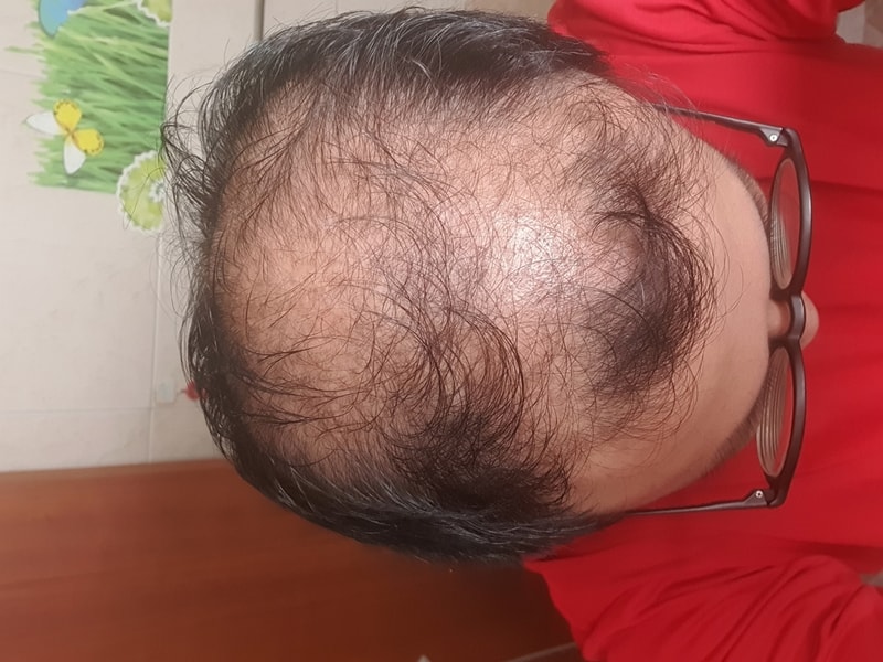 심각한 내머리.. 약먹어야겠죠? ㅜㅜ