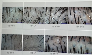 2023,2024 1년간 모발 밀도 및 굵기 변화