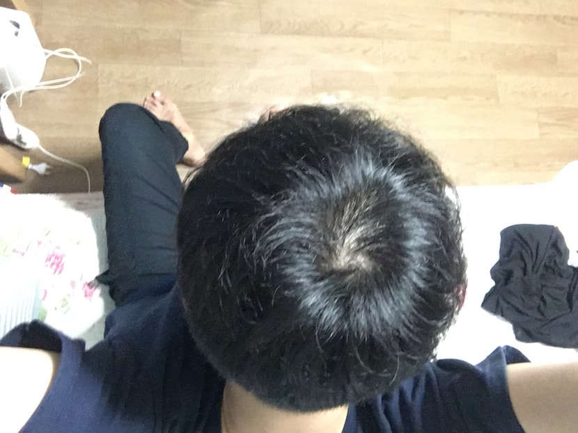 오늘 방금찍은 복용 233일차 (4)