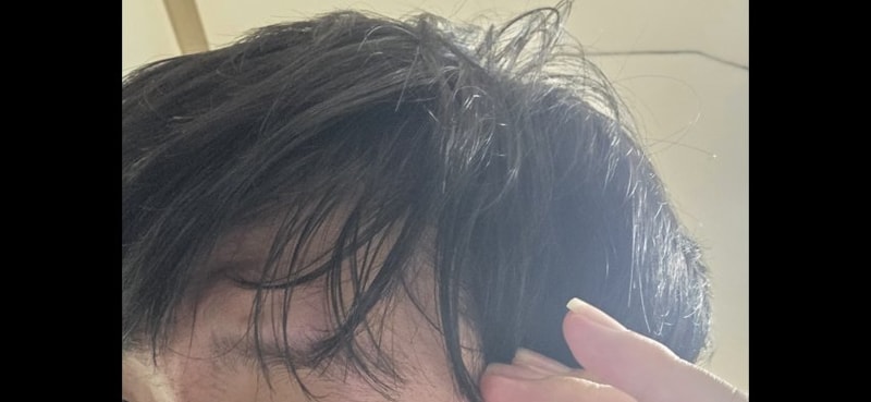 두피염으로 인해 특정부분이 탈모가 일어나고 회복이 더이상안되고 있는 상황입니다...