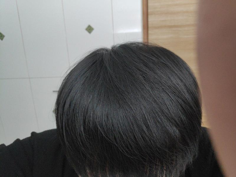 もうすぐ40代の髪（植毛後ケア9年目）