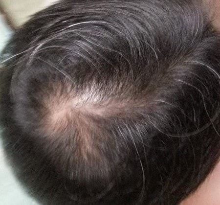 피나 1년 10개월 복용했습니다