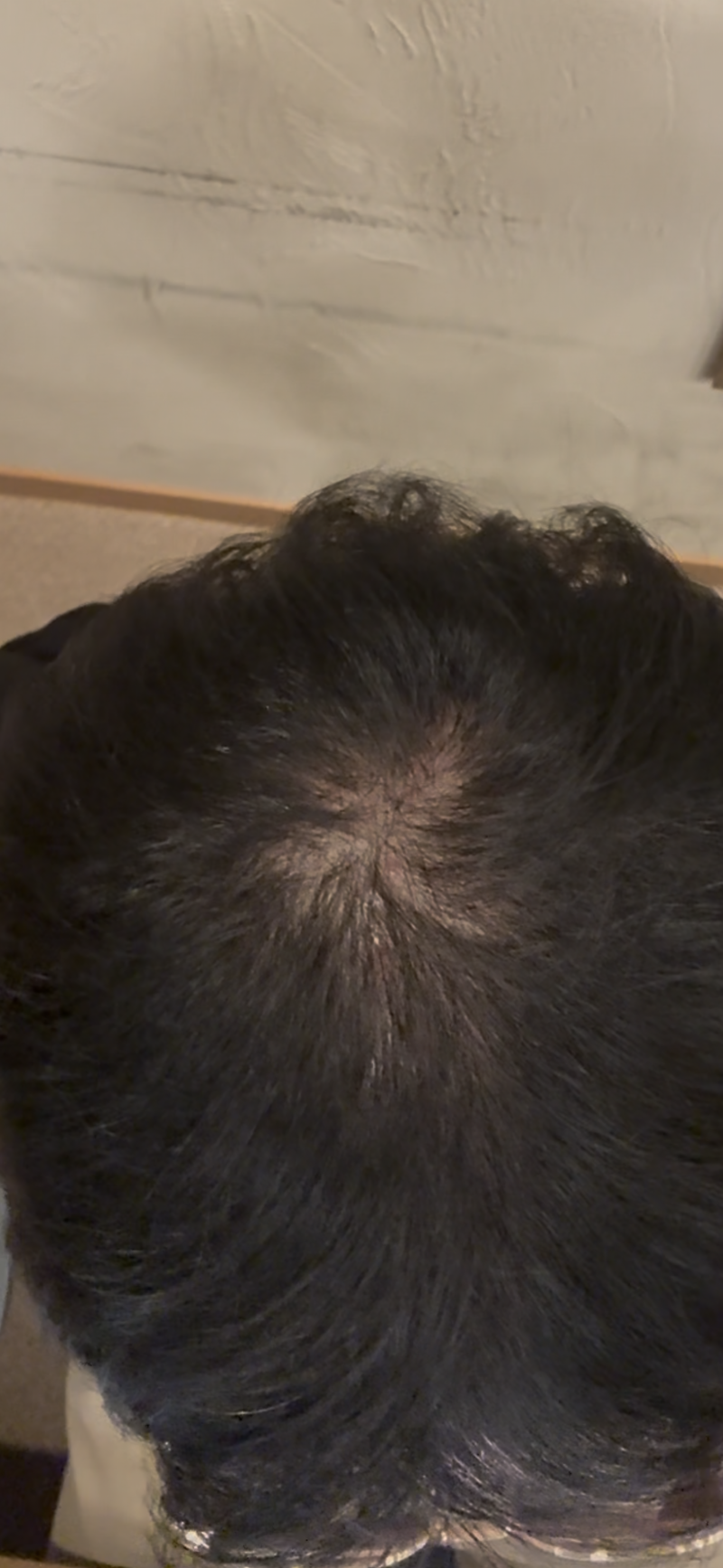 hair loss at the top of the head