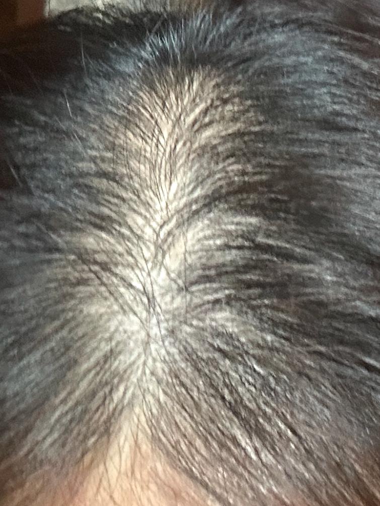 ミノキシディルを食べるかどうか悩んでいるので投票をお願いします