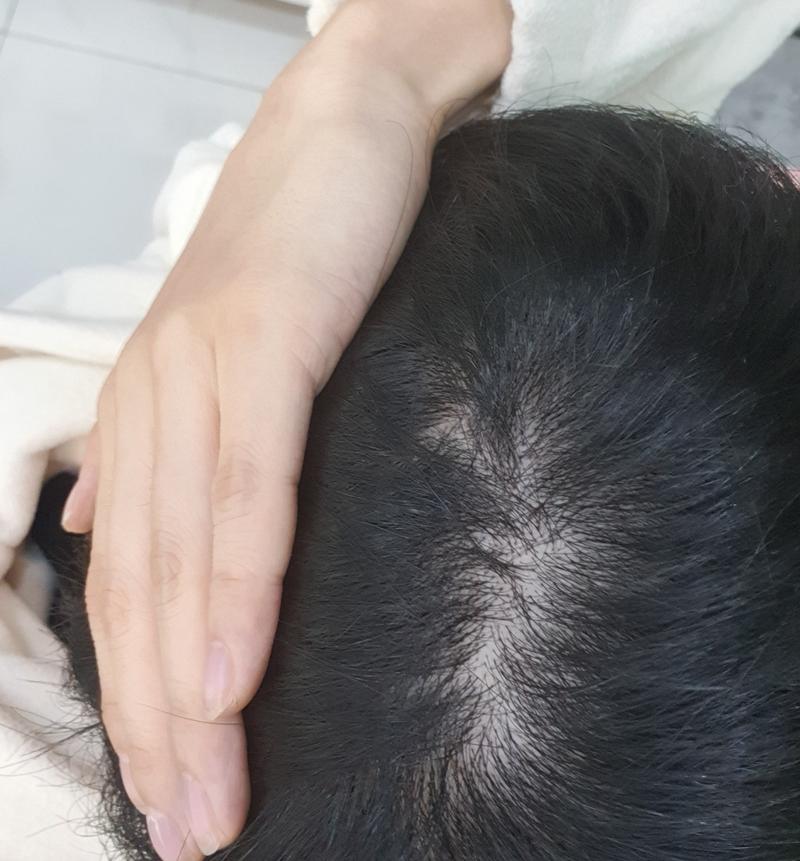 이정도면 탈모초기라고 봐도 되는거죠..?