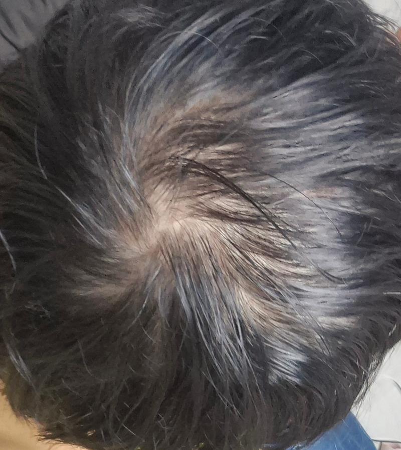 25歳の頭頂部薄毛の悩みです。