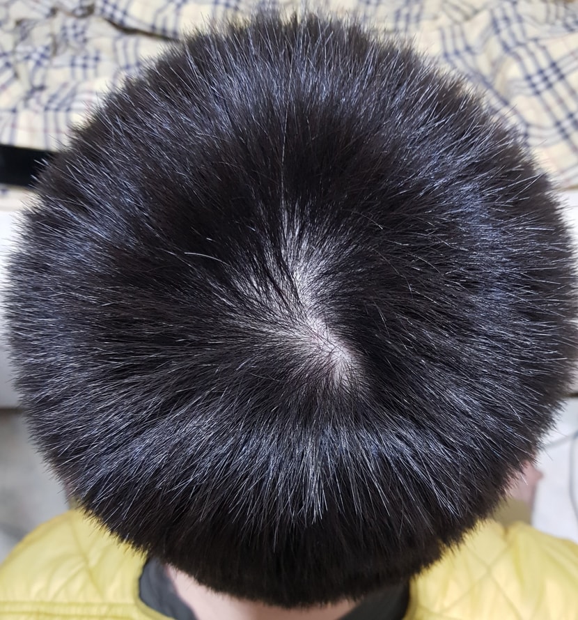 정수리