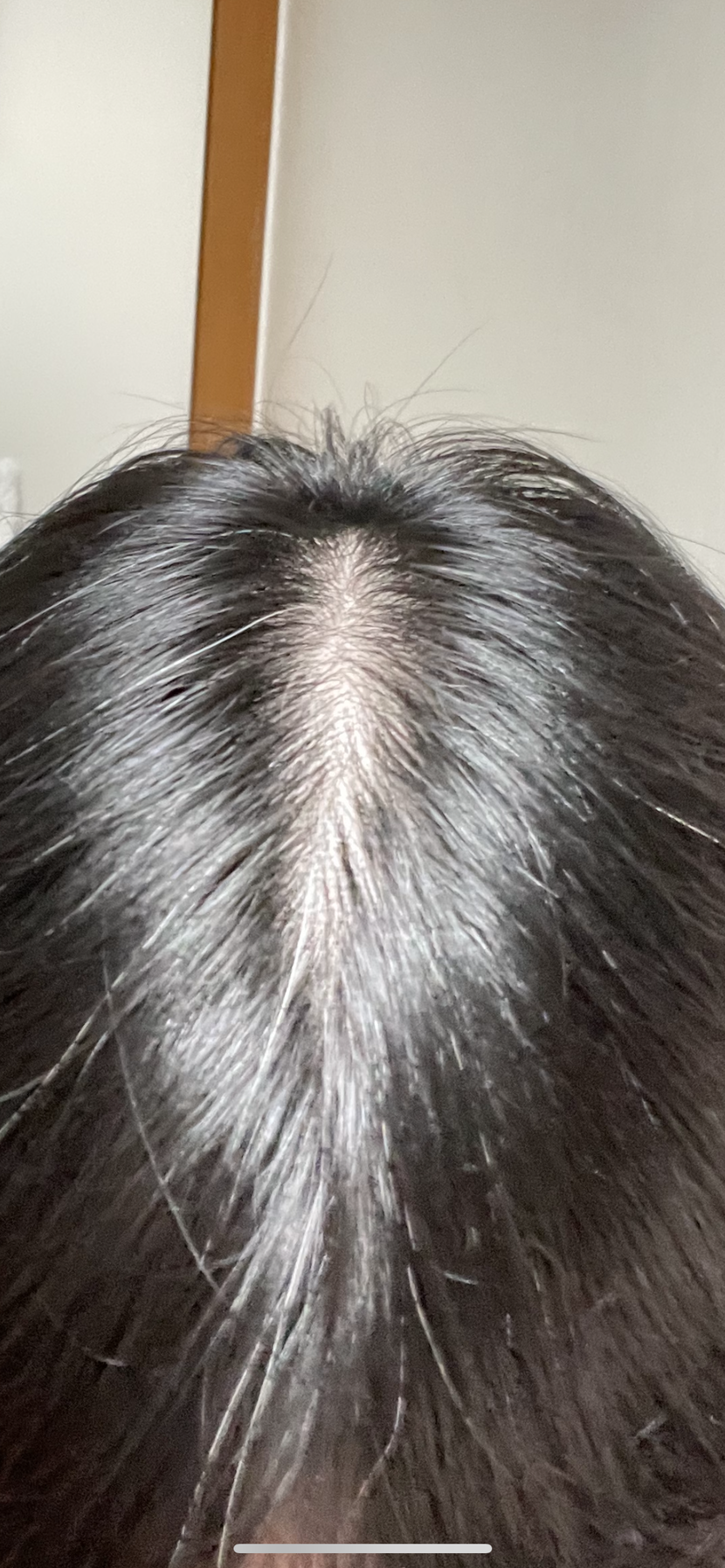 이건 약 4개월 전인데 저 때보다 더 심해진 것 같습니다.. 펌을 받아서 그런 것 같기도 하고..