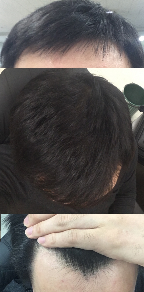 탈모사진